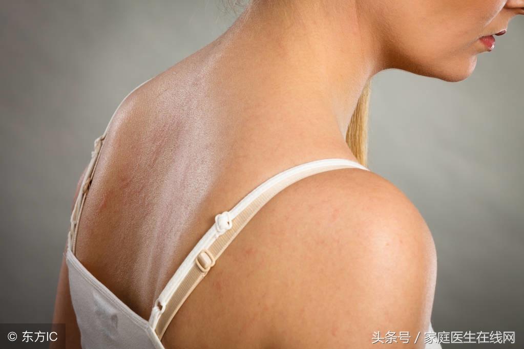 后背长痘痘怎么办，做好这4件事不发愁