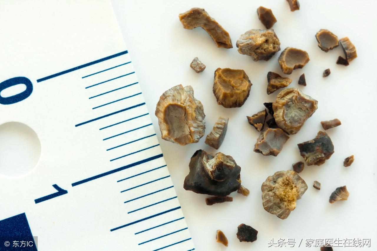 肾结石的危害，什么方法可预防肾结石