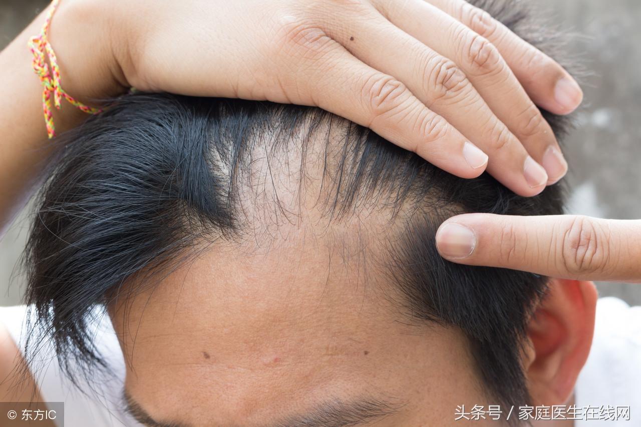头发掉的厉害是怎么回事，可能是这4个原因导致