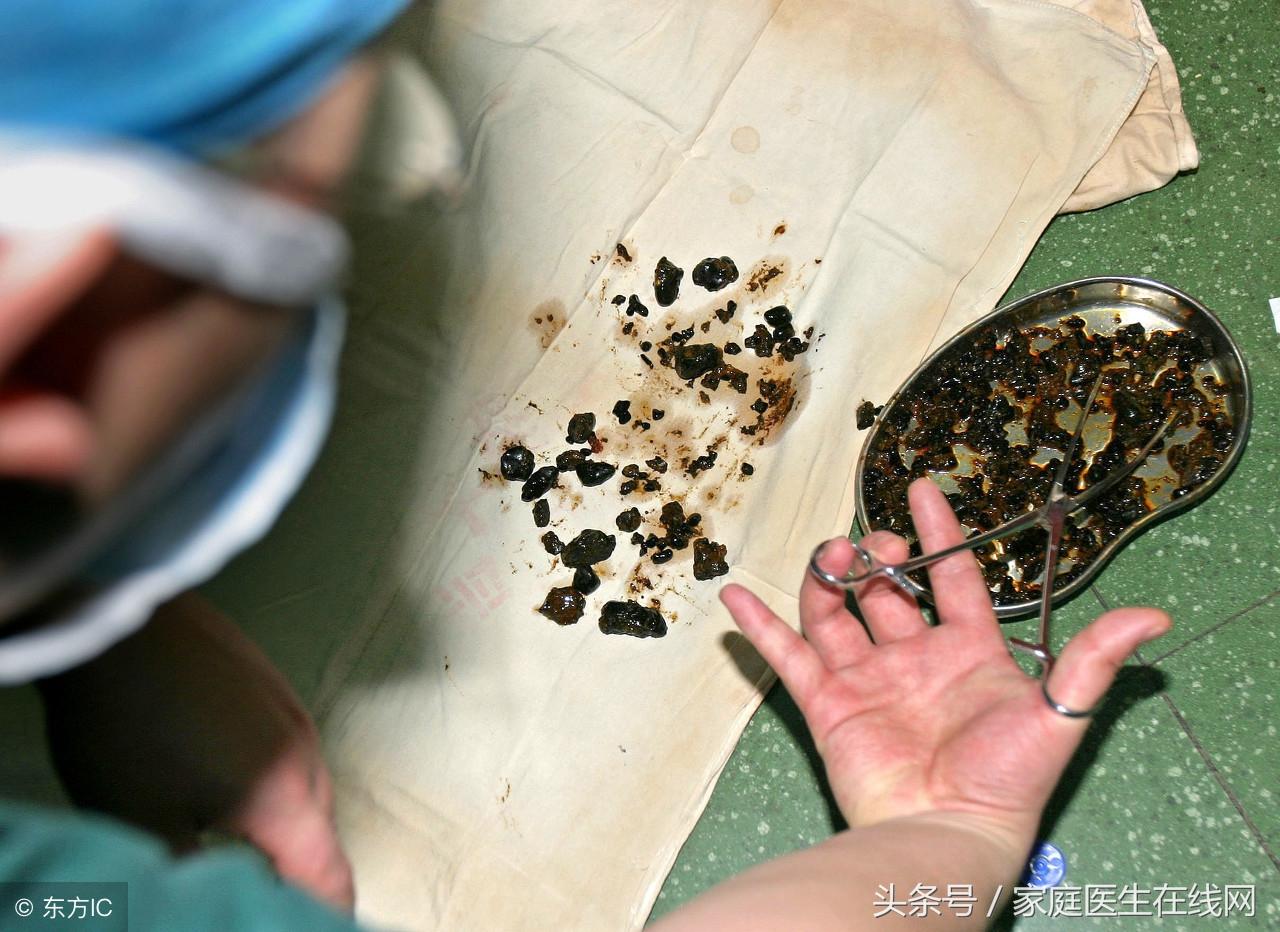 肾结石的早期症状，肾结石患者注意事项