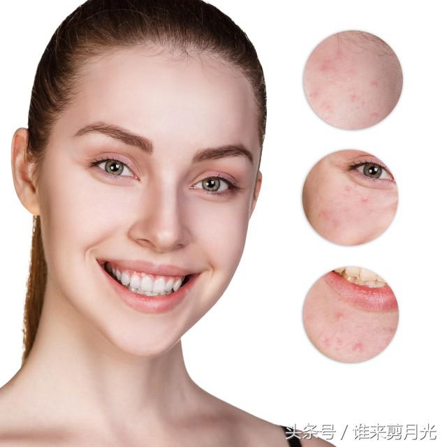 额头下巴长痘的原因，告诉你这3个