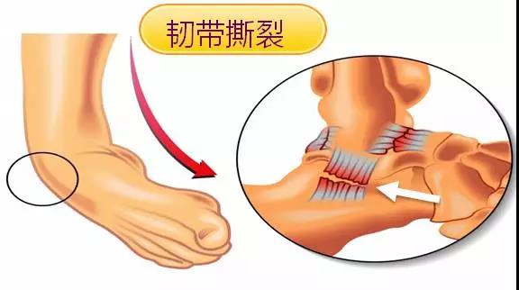 脚扭了怎么办，处理方法有哪些