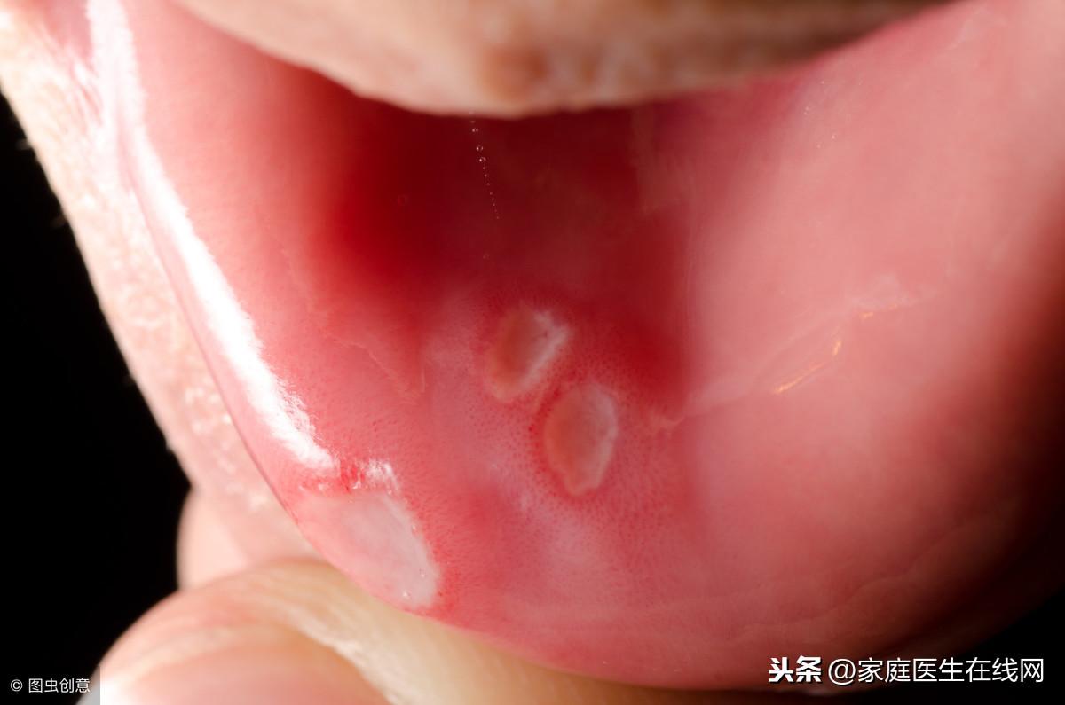 口腔溃疡的原因，这3个病因要留意