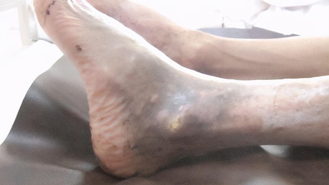 骨髓炎症状，骨髓炎的四个典型症状
