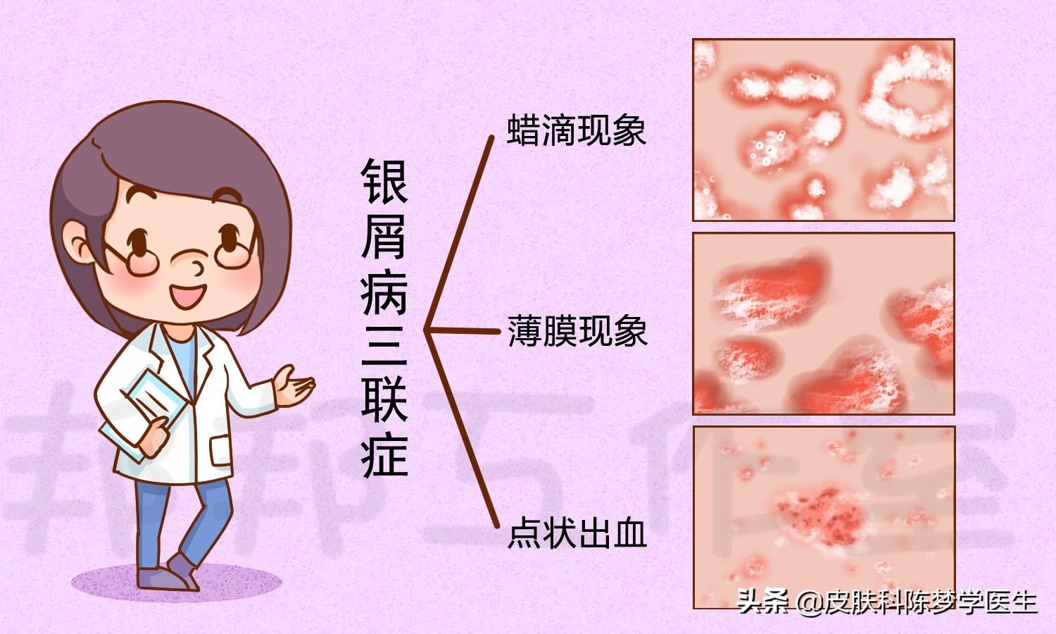 牛皮癣的症状，牛皮癣的三大特征