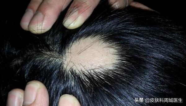斑秃治疗方法，为什么会出现斑秃？