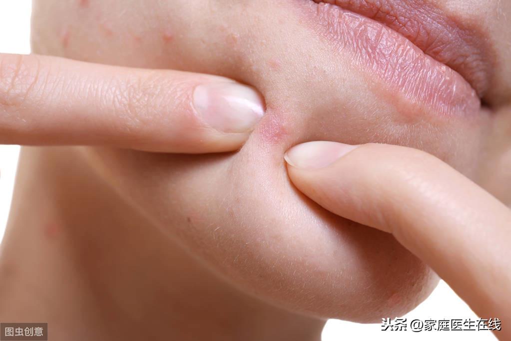 脸上长了痤疮怎么办，教你3种方法来消除