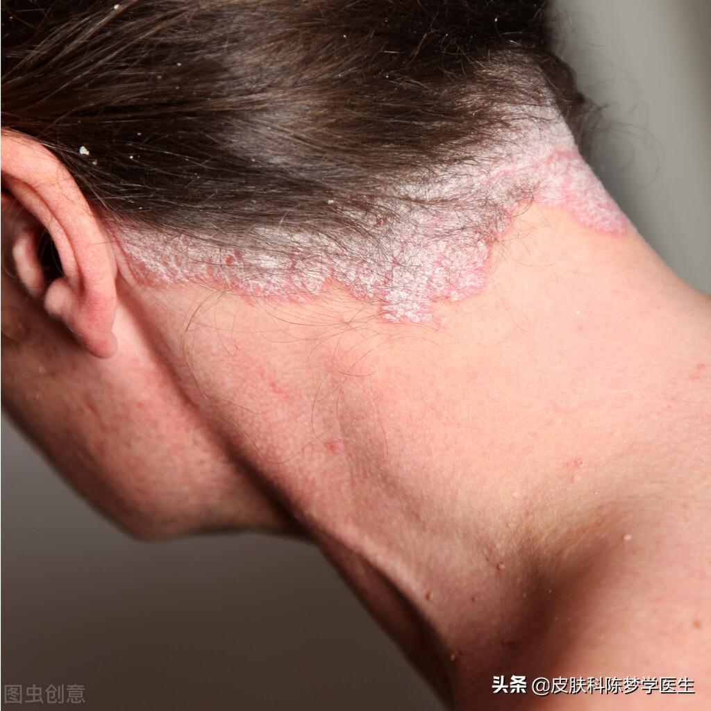 牛皮癣的症状，牛皮癣的三大特征