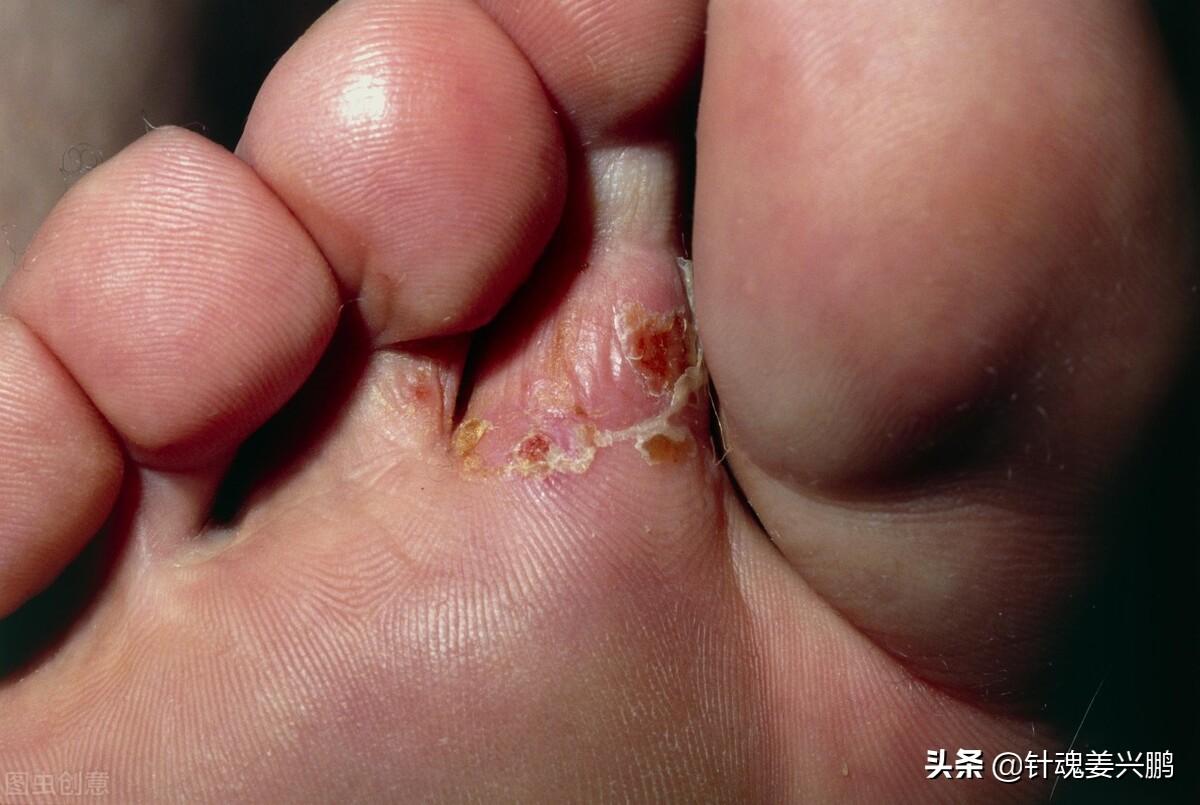 脚气的最好治疗方法，3个人人实用的方法
