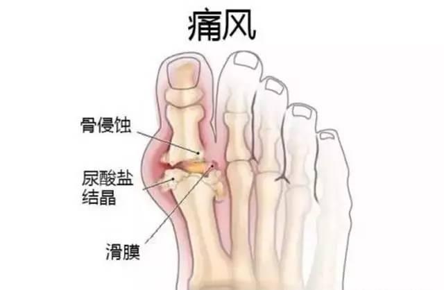 尿酸高吃什么食物好，这3种天然食物帮助降尿酸