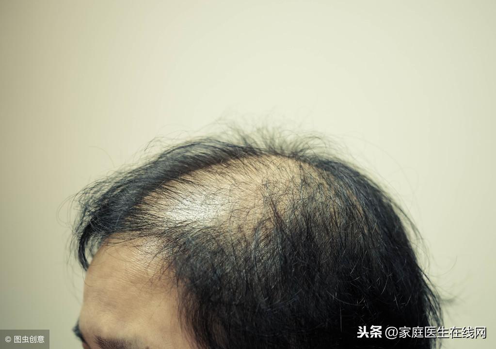 掉头发怎么回事，3个原因要重视