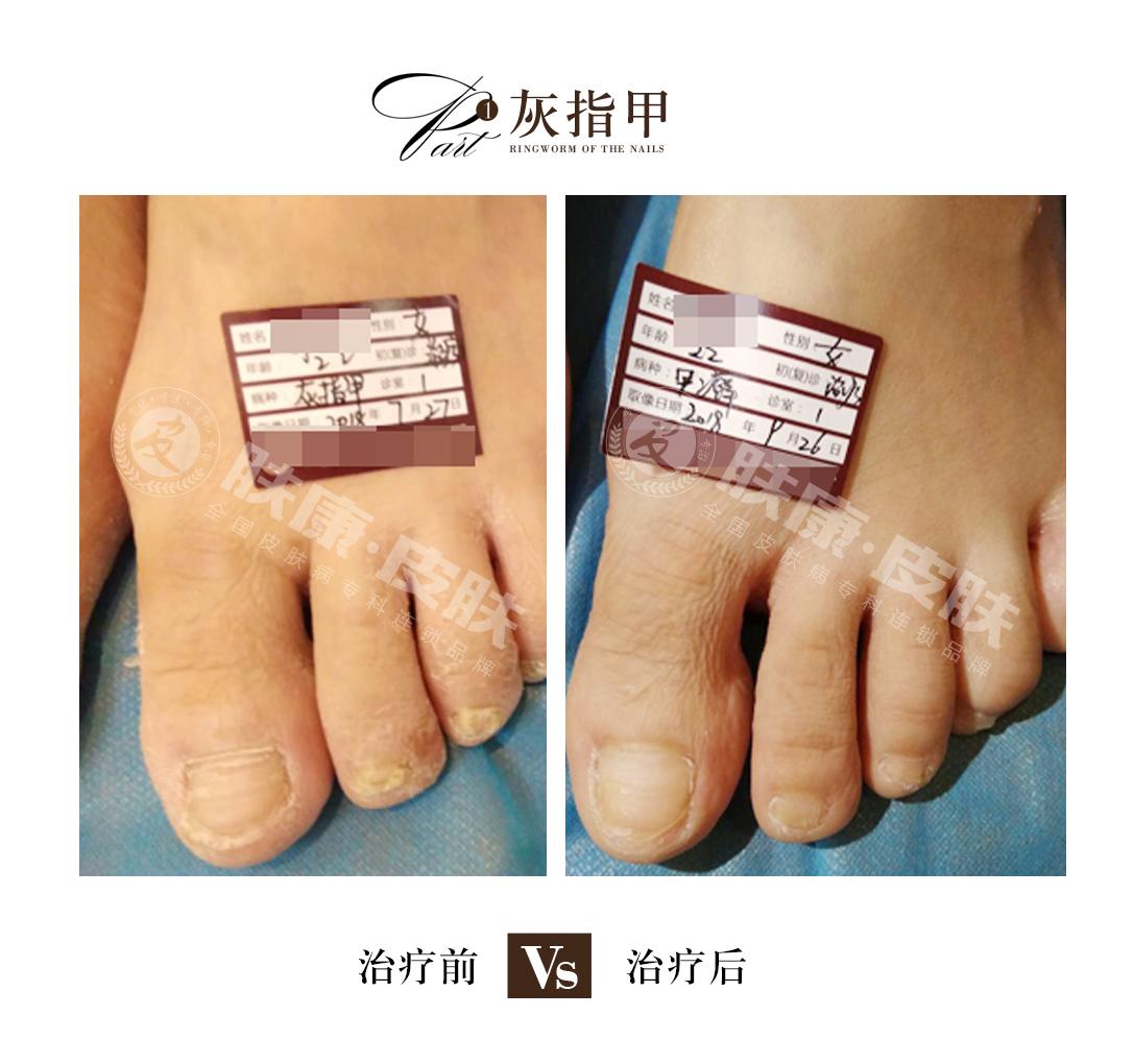 怎样治疗灰指甲，4种方法助指甲恢复