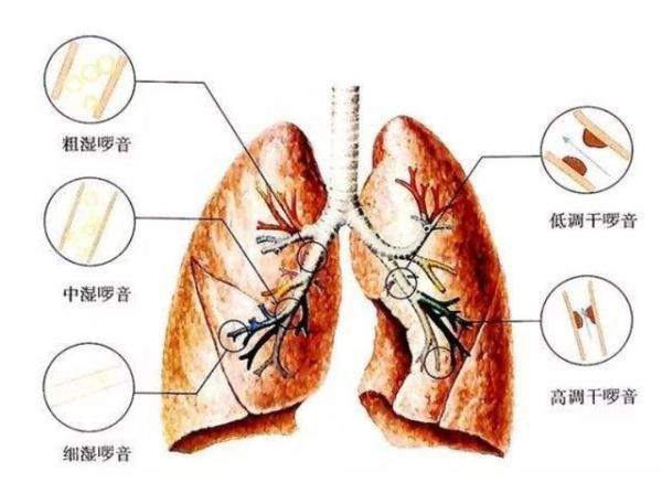 宝宝肺炎症状，这五种症状你要知道