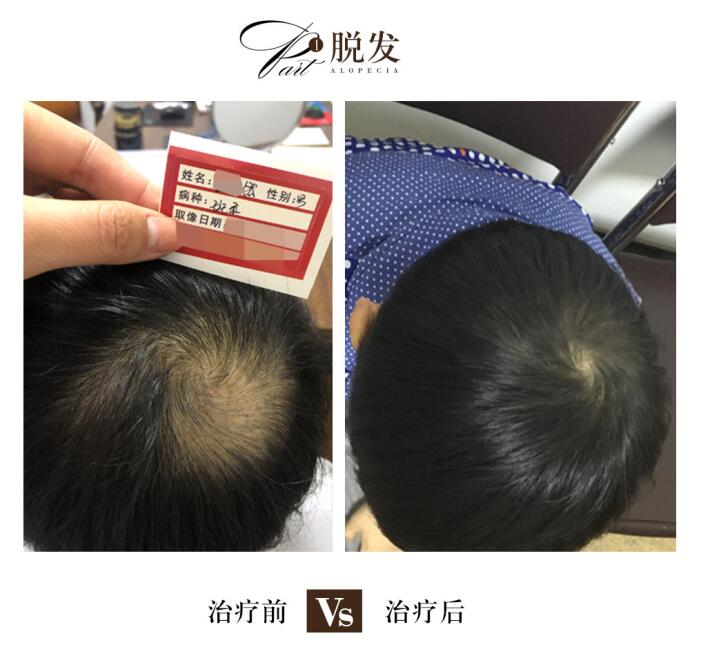 头发稀少的原因，掉发的原因有哪些？
