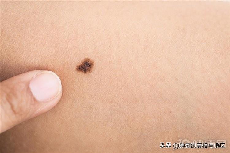 皮肤癌早期症状，身体会给出5个“反应”