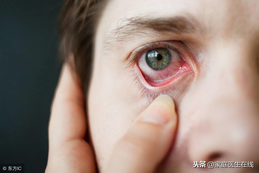 红眼病症状，3个红眼病的症状需要知道