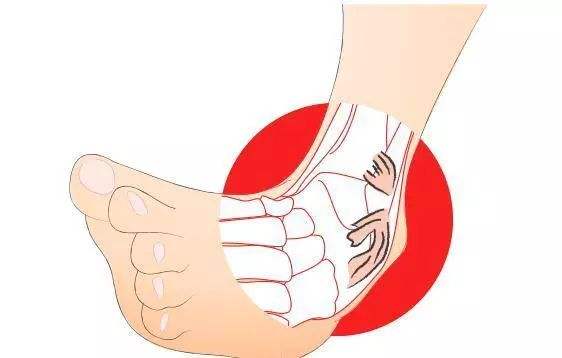 脚扭了怎么办，处理方法有哪些