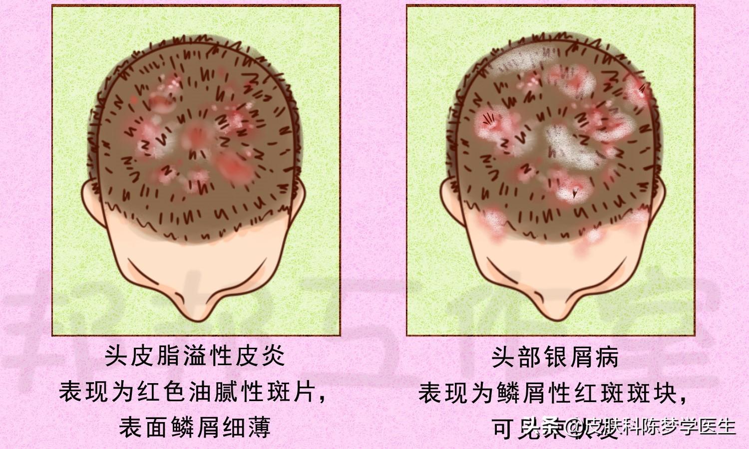 牛皮癣的症状，牛皮癣的三大特征