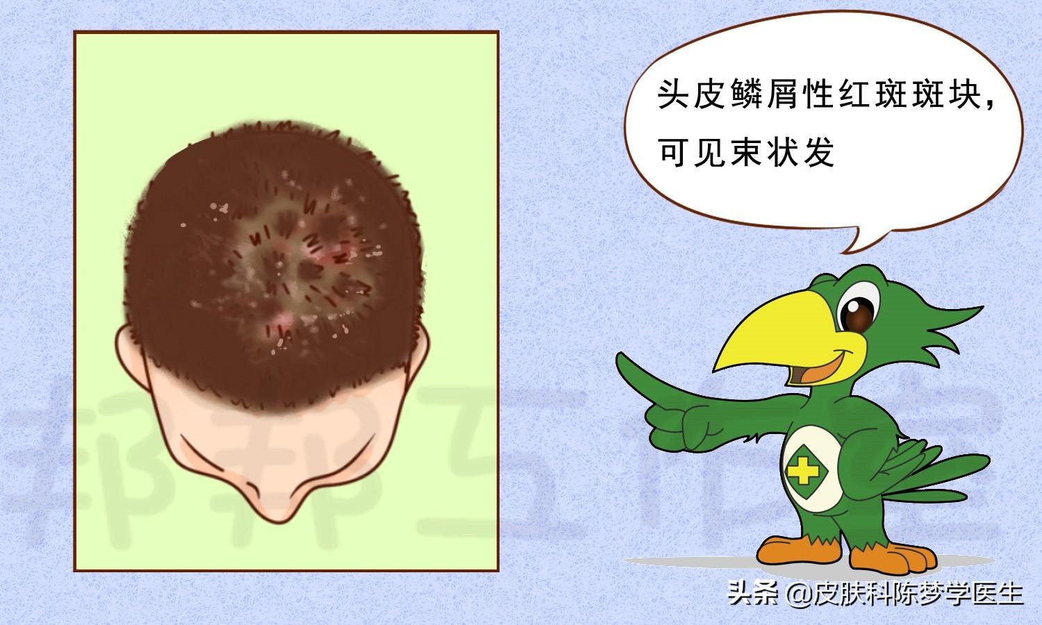 牛皮癣的症状，牛皮癣的三大特征