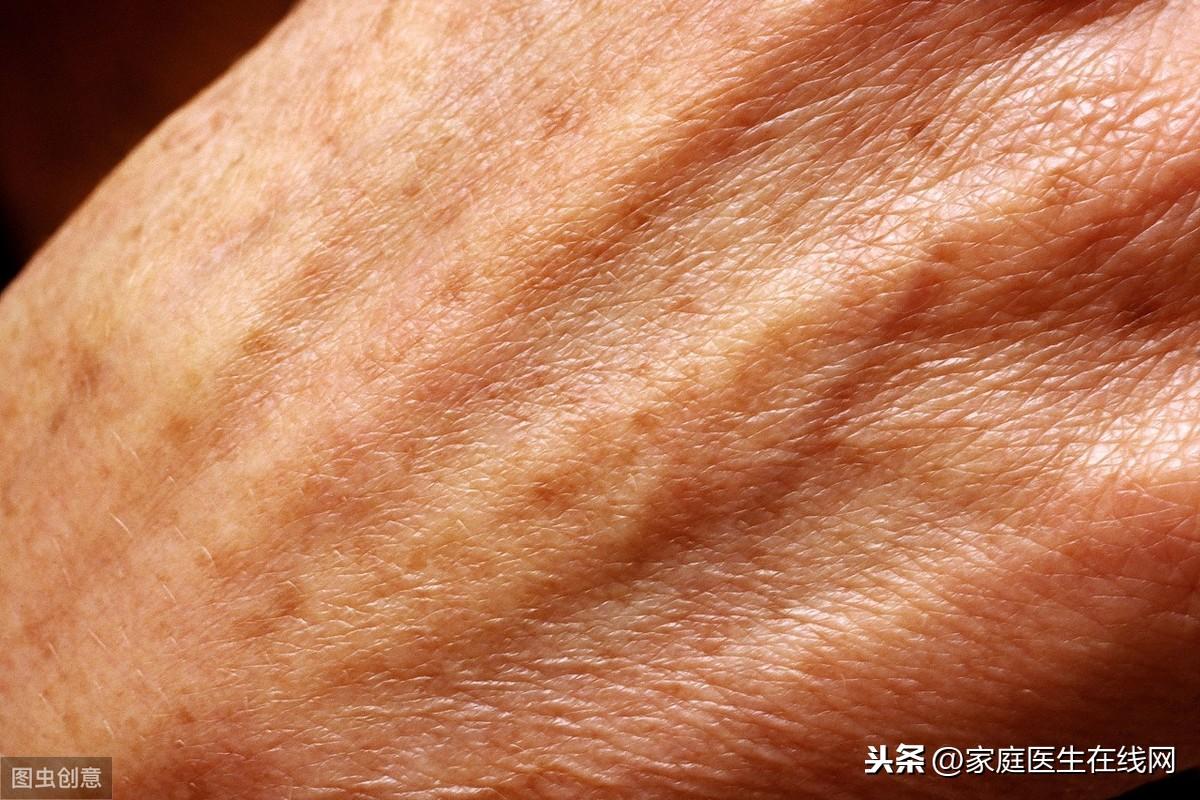 老年斑怎么治，做好这2点，可以淡化