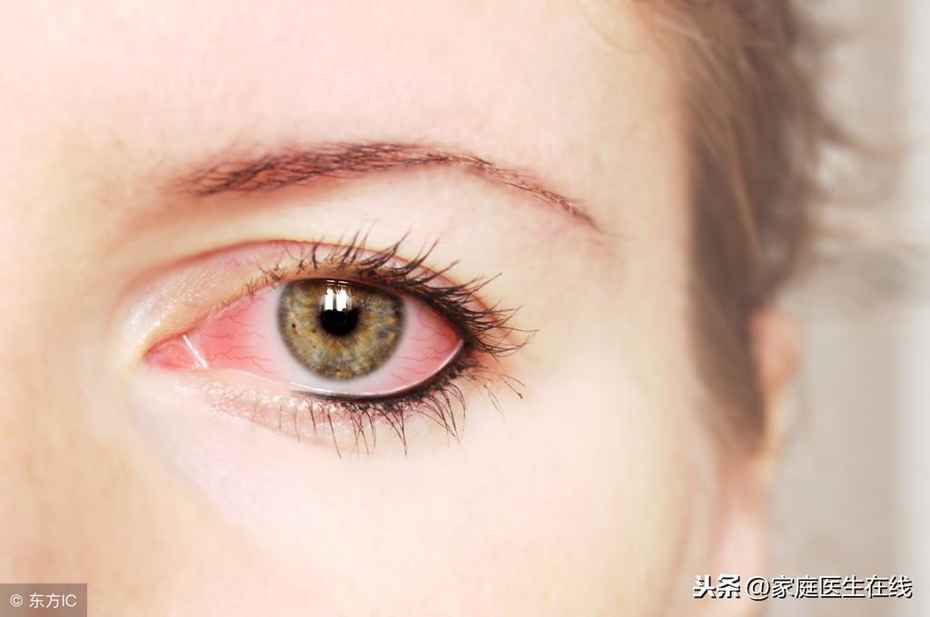 红眼病症状，3个红眼病的症状需要知道