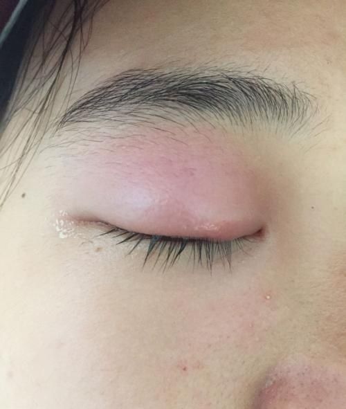 肾衰竭的早期症状，3个早期症状别忽视