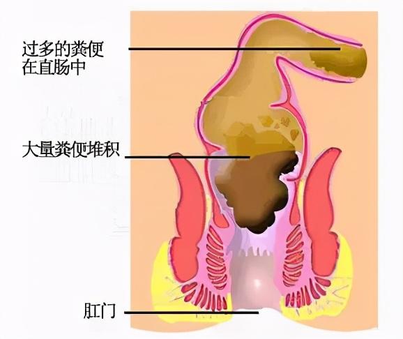 便秘的症状，便秘的四个类型