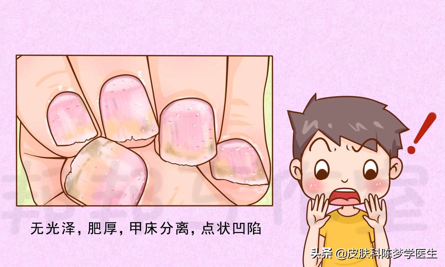 牛皮癣的症状，牛皮癣的三大特征