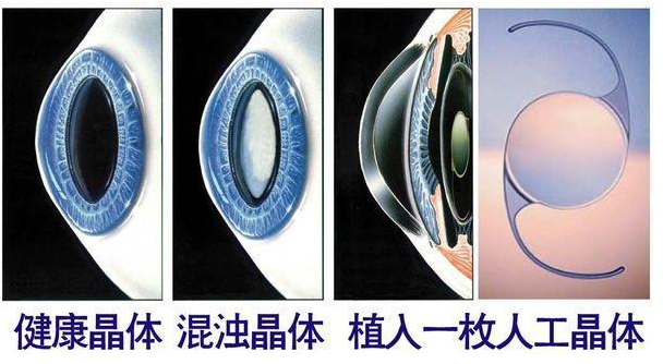 白内障治疗方法，白内障一般会做哪些检查