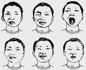 面瘫的分类和临床表现