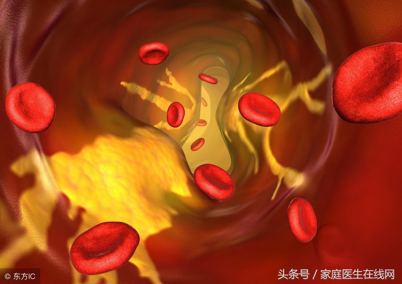 动脉硬化症状，出现动脉硬化4个症状，及时就医