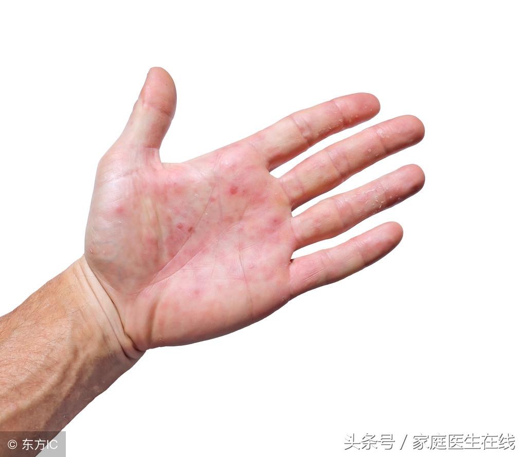 脉管炎的症状以及治疗方法