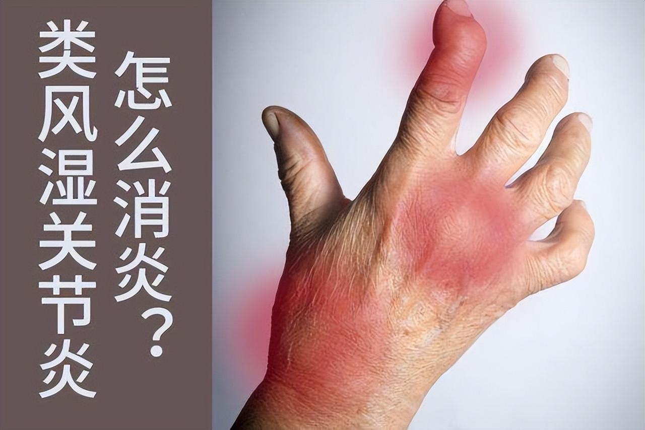 类风湿的治疗方法，四种方法，治疗类风湿