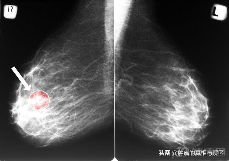 乳腺癌的早期症状，有这5个变化就要去找医生