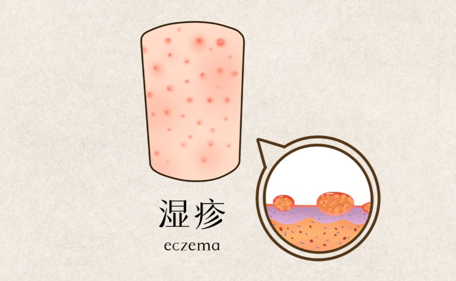 湿疹的症状与治疗，医师教你4招止痒