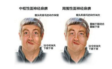 面瘫的分类和临床表现