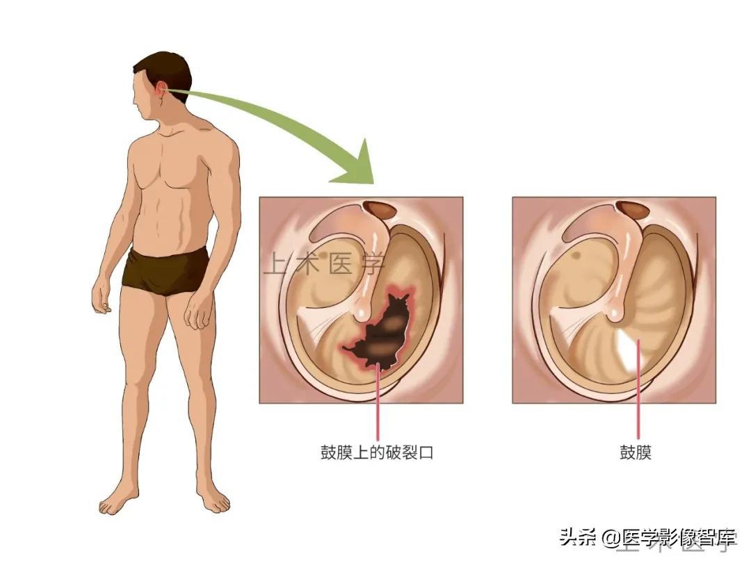 鼓膜穿孔症状和治疗措施
