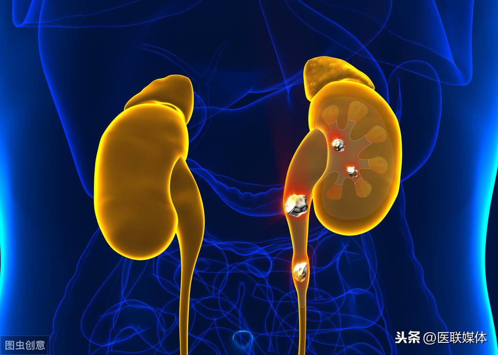 肾结石的食疗，多吃这5种食物，促使结石排出