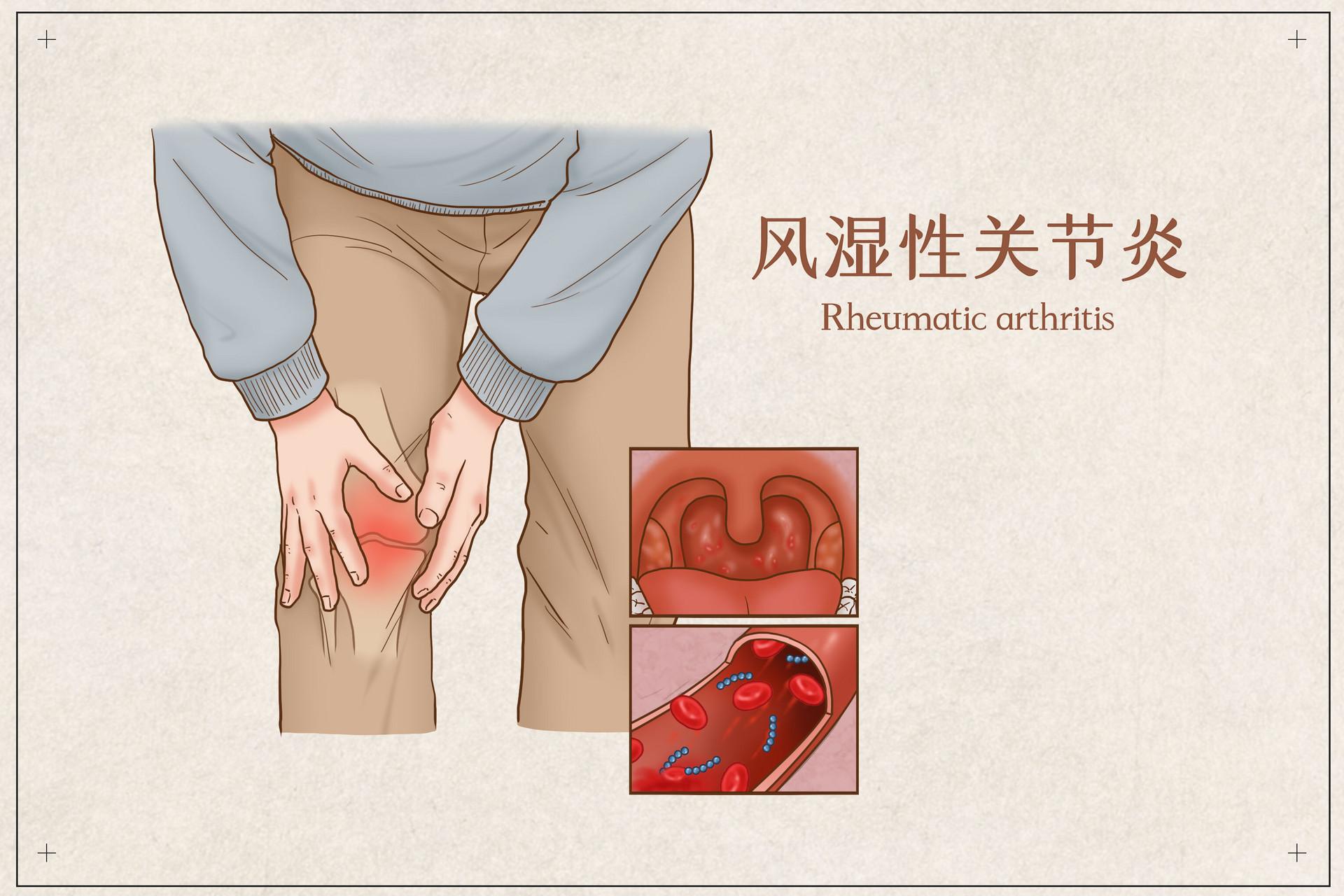 风湿热是怎么回事，一文读懂风湿热