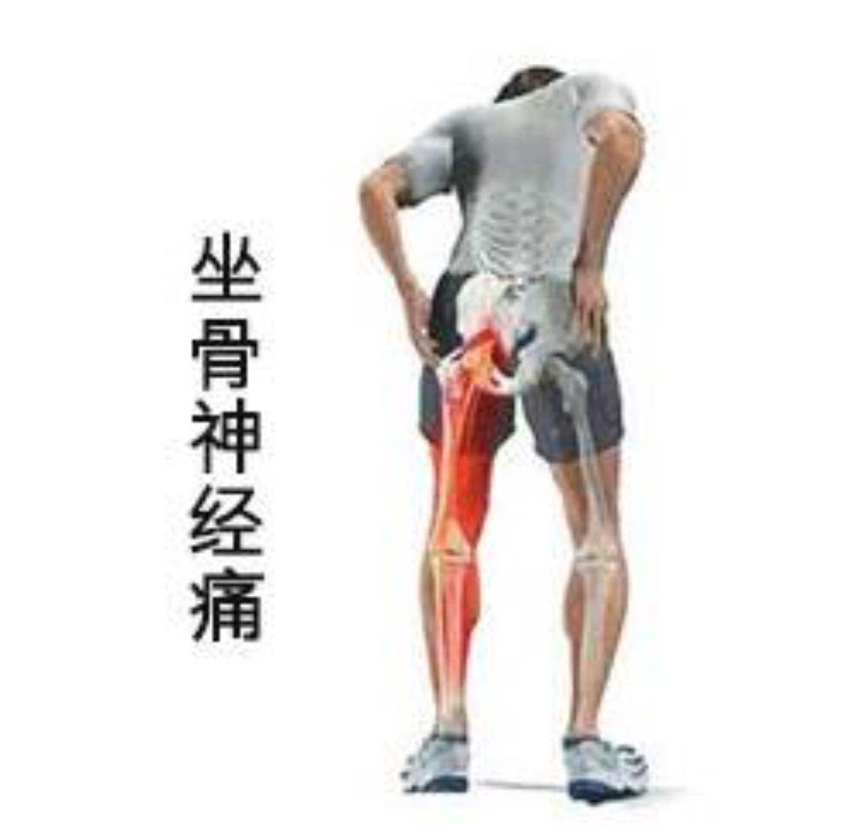 坐骨神经痛的症状，预防方法具体有什么