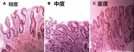 胃病症状，胃病的10个症状要注意