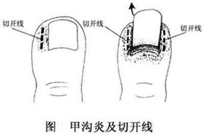 甲沟炎的治疗方法，一个小妙招，甲沟炎不再发