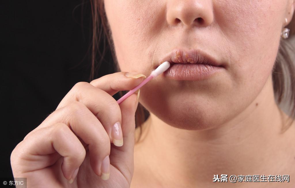 嘴角起泡怎么办，采取4个措施能加快恢复