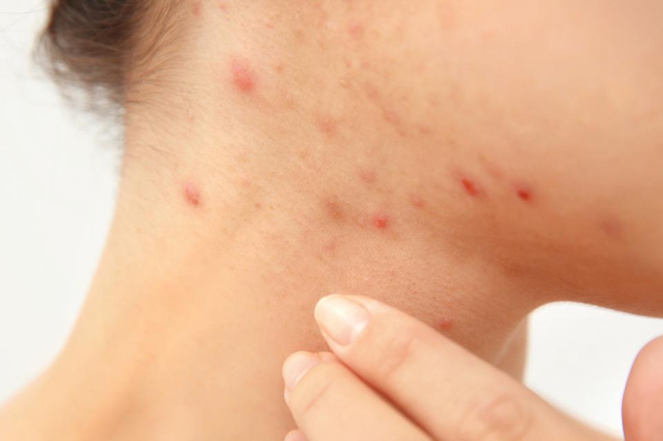 痤疮的治疗方法，医生治痤疮常用3种方式