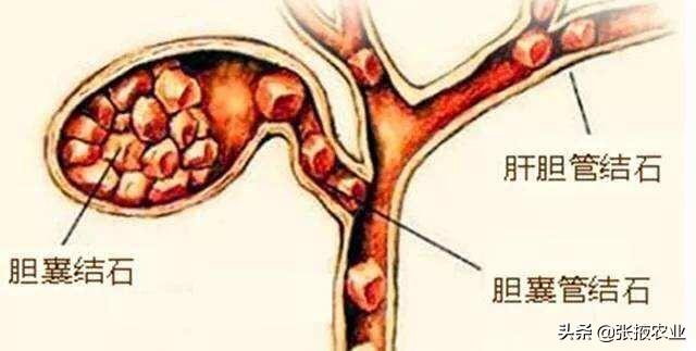 胆囊炎的症状，胆囊炎不能吃什么?