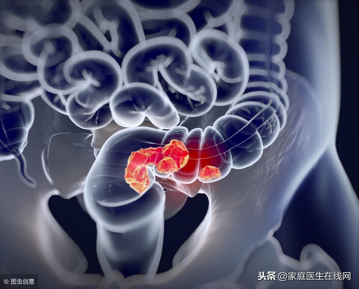 肠癌有什么症状，4个感受，要放在心上