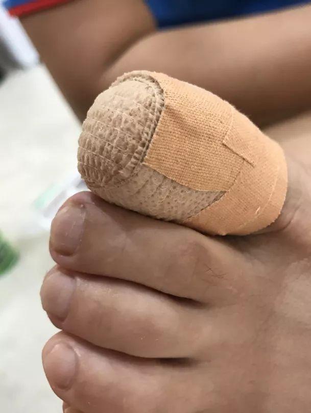 怎么治疗灰指甲，教你3招，治好不复发