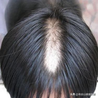斑秃的原因，3种原因对症治疗