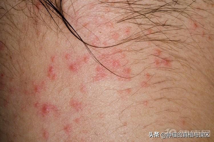 淋巴癌症状有哪些，淋巴癌自我检测